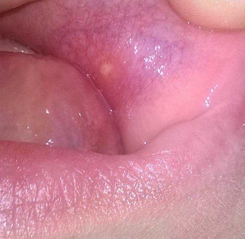 Download Pickel Im Mund Zahnfleisch Pics