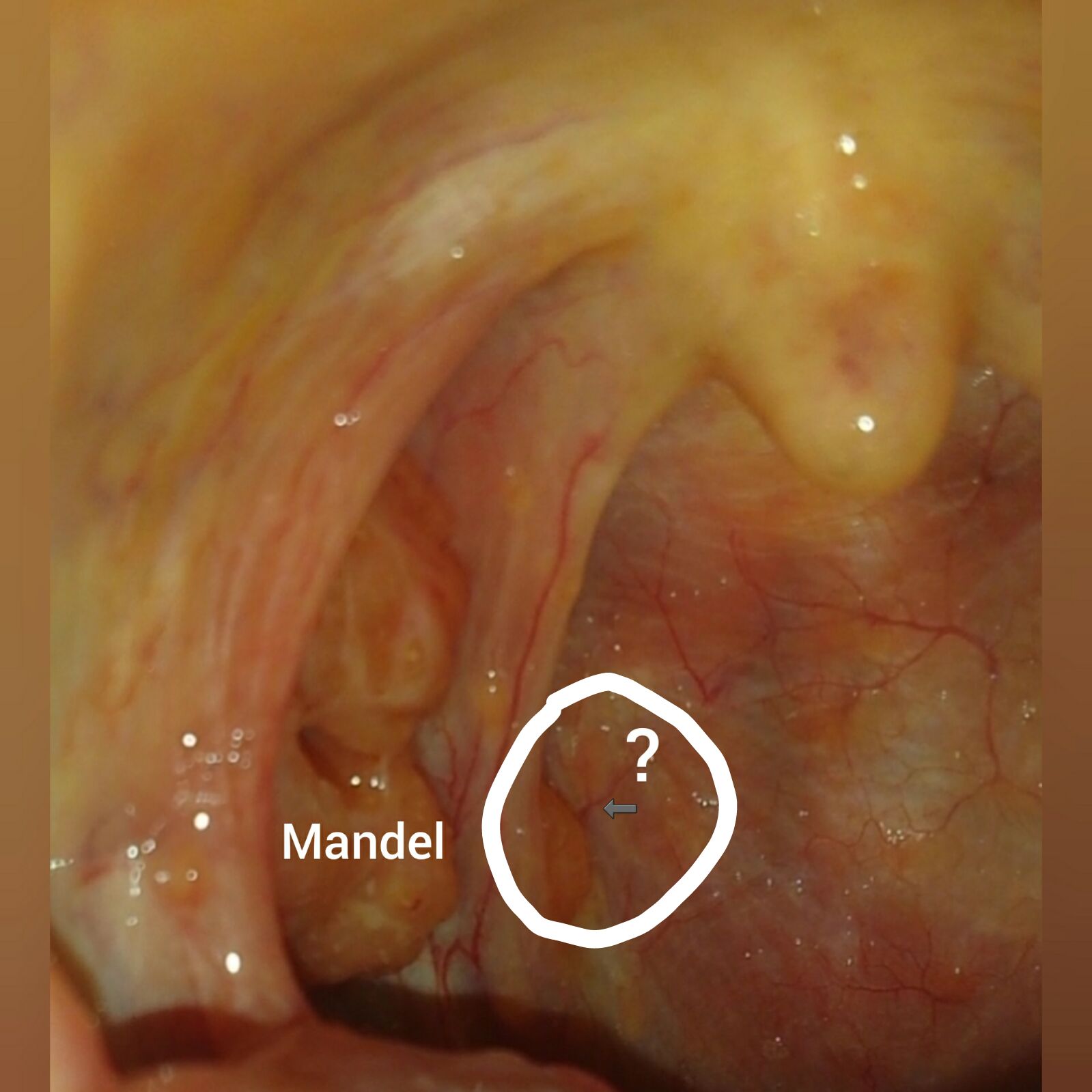 46+ Blaeschen im rachen bilder , Was ist das in meinem Rachen (mit Bild)? (Gesundheit und Medizin