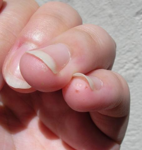 Kleiner Finger und Ringfinger betroffen - (Hautkrankheit, kapillare, Psysiologie)