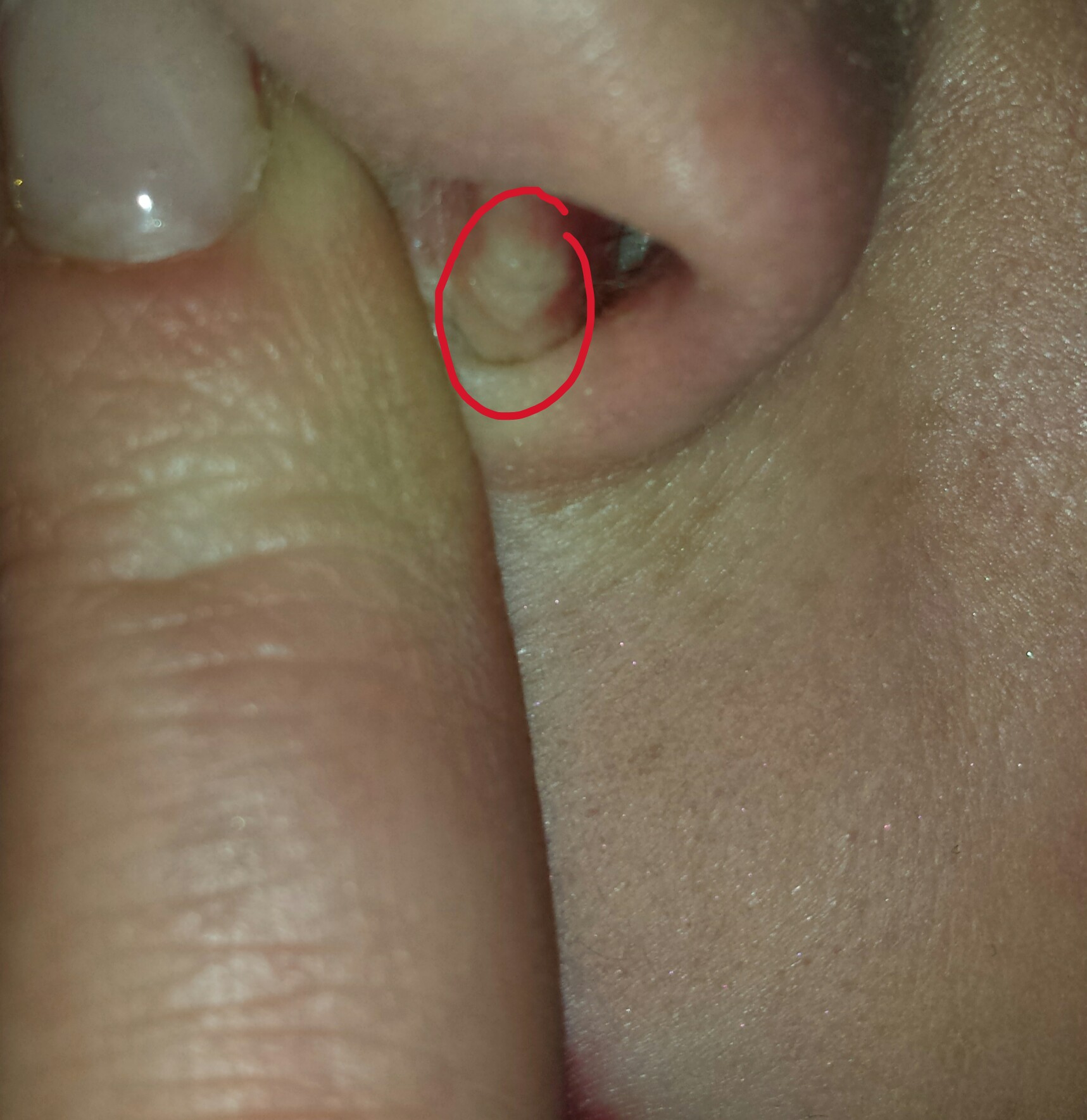Was Ist Das In Meiner Nase Warze Tumor Hno Warzen Was Ist Das In Meiner Nase Warze Tumor Hno Warzen