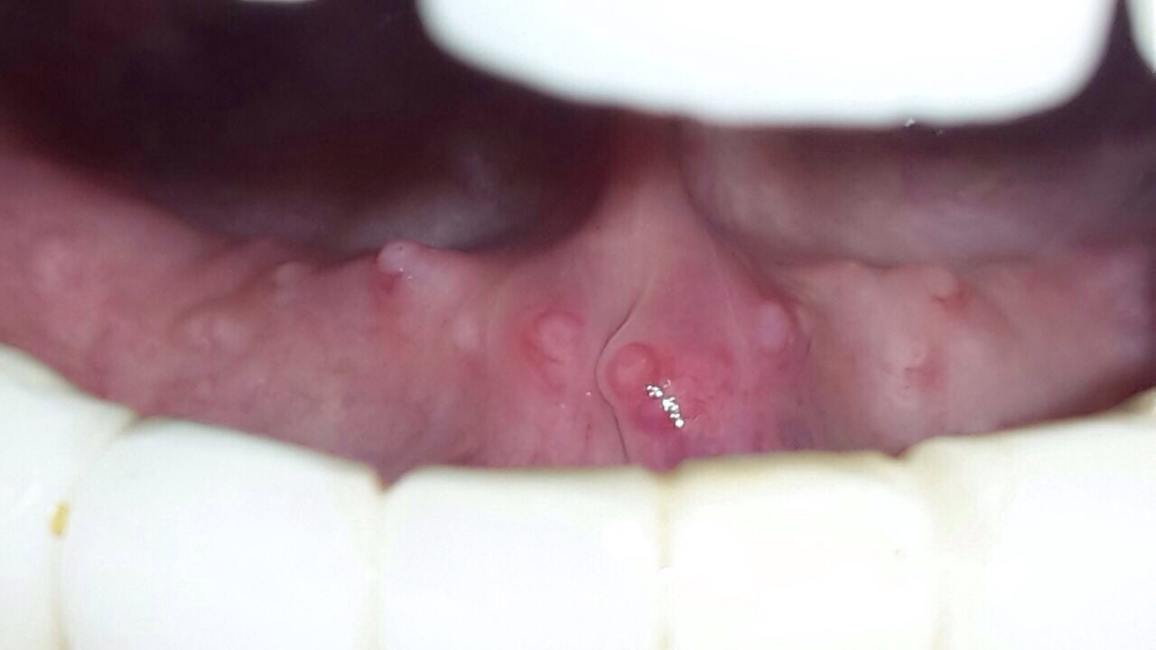 Download Kleine Pickel Auf Der Zunge Hinten Images