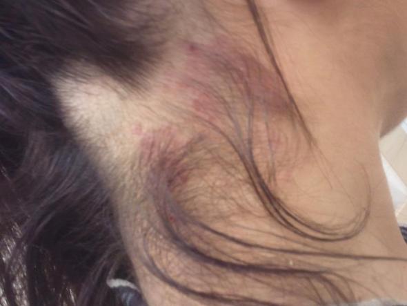 Was Ist Das Kann Mir Jemand Mal Helfen Neurodermitis