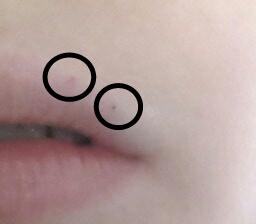 Was Ist Das Kleine Punkte Uber Meiner Lippe Gesundheit Korper