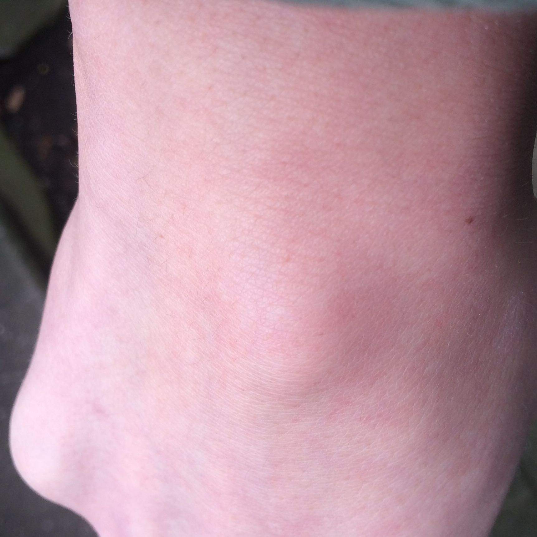 Was ist das?(Knubbel am Handgelenk) (Medizin, Schwellung, Tumor)