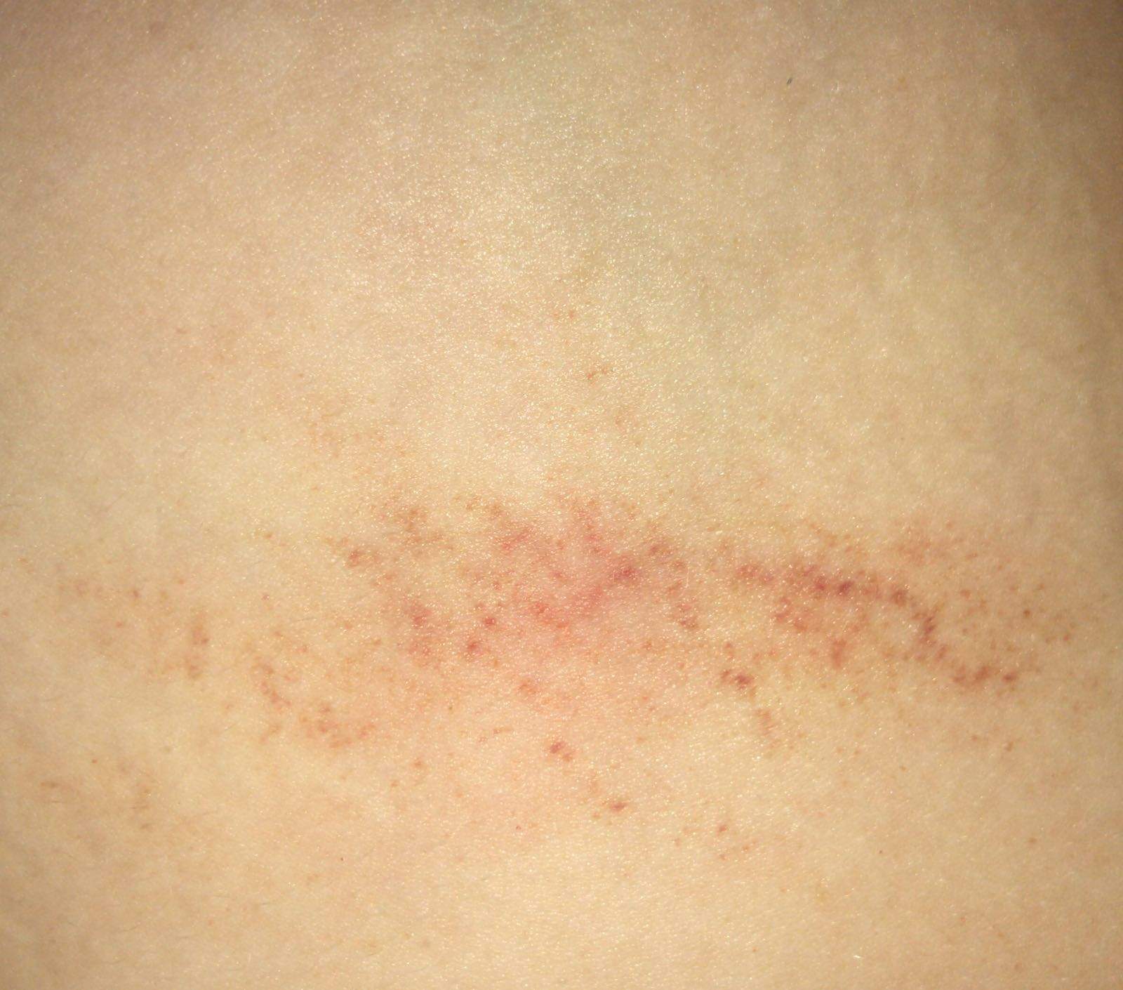 Ohne machen flasche knutschfleck selber hals Knutschfleck machen