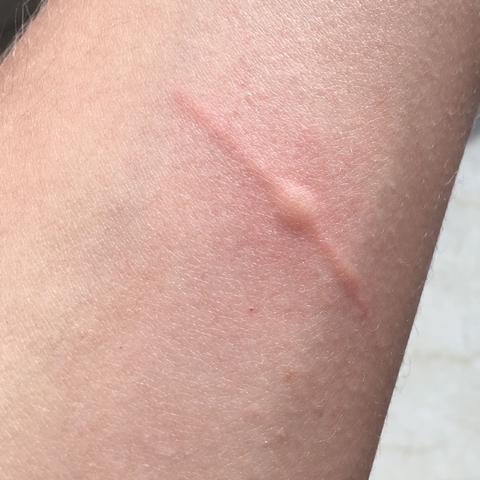 Mein Arm - (Arzt, Haut, Allergie)