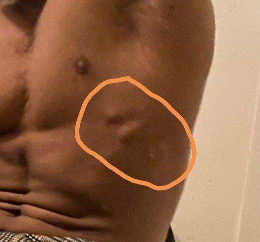 Was Ist Das Krebs Oder Zyste Medizin Haut Was Ist Das Krebs Oder Zyste Medizin Haut