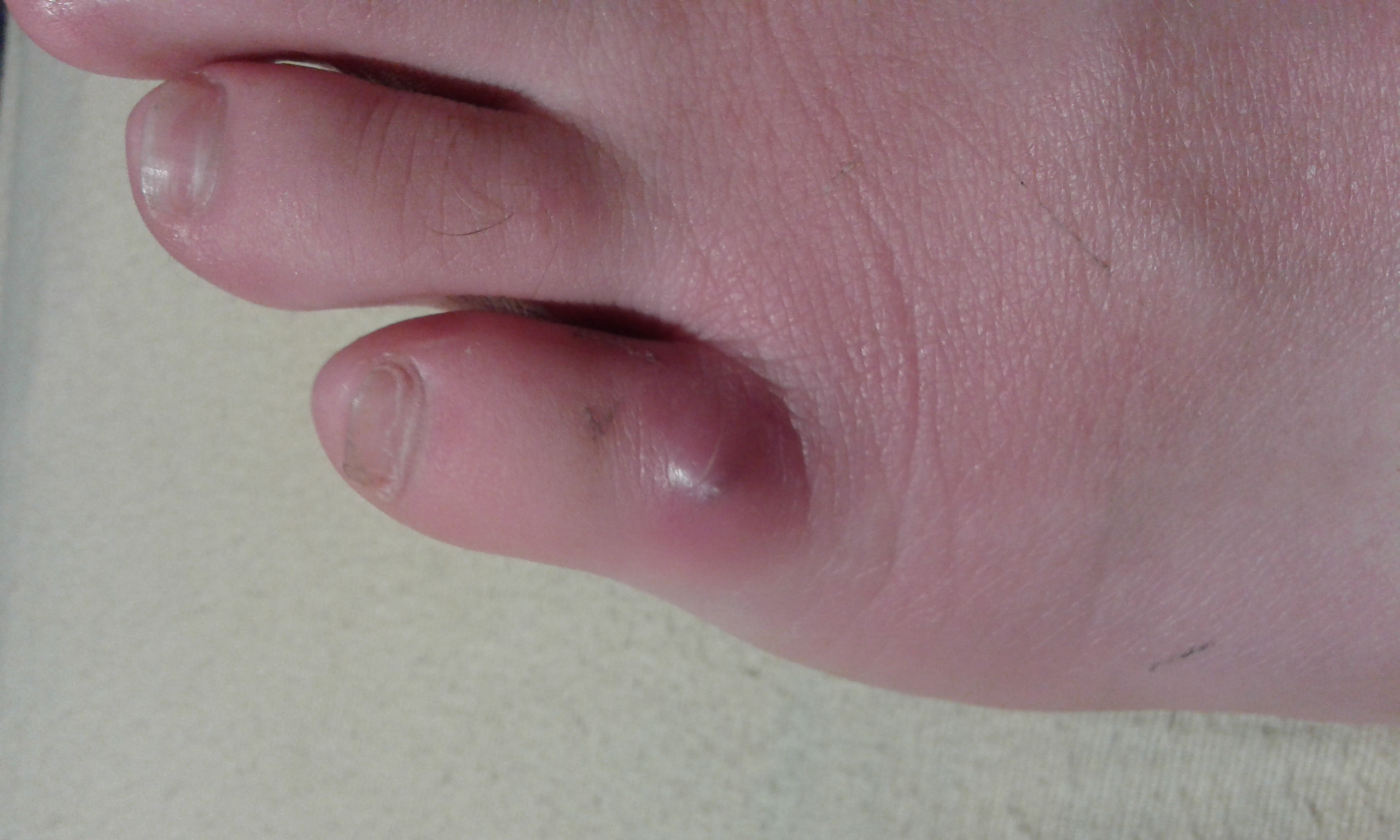 Was ist das (mit bild) zehe ? (Gesundheit, Füße)