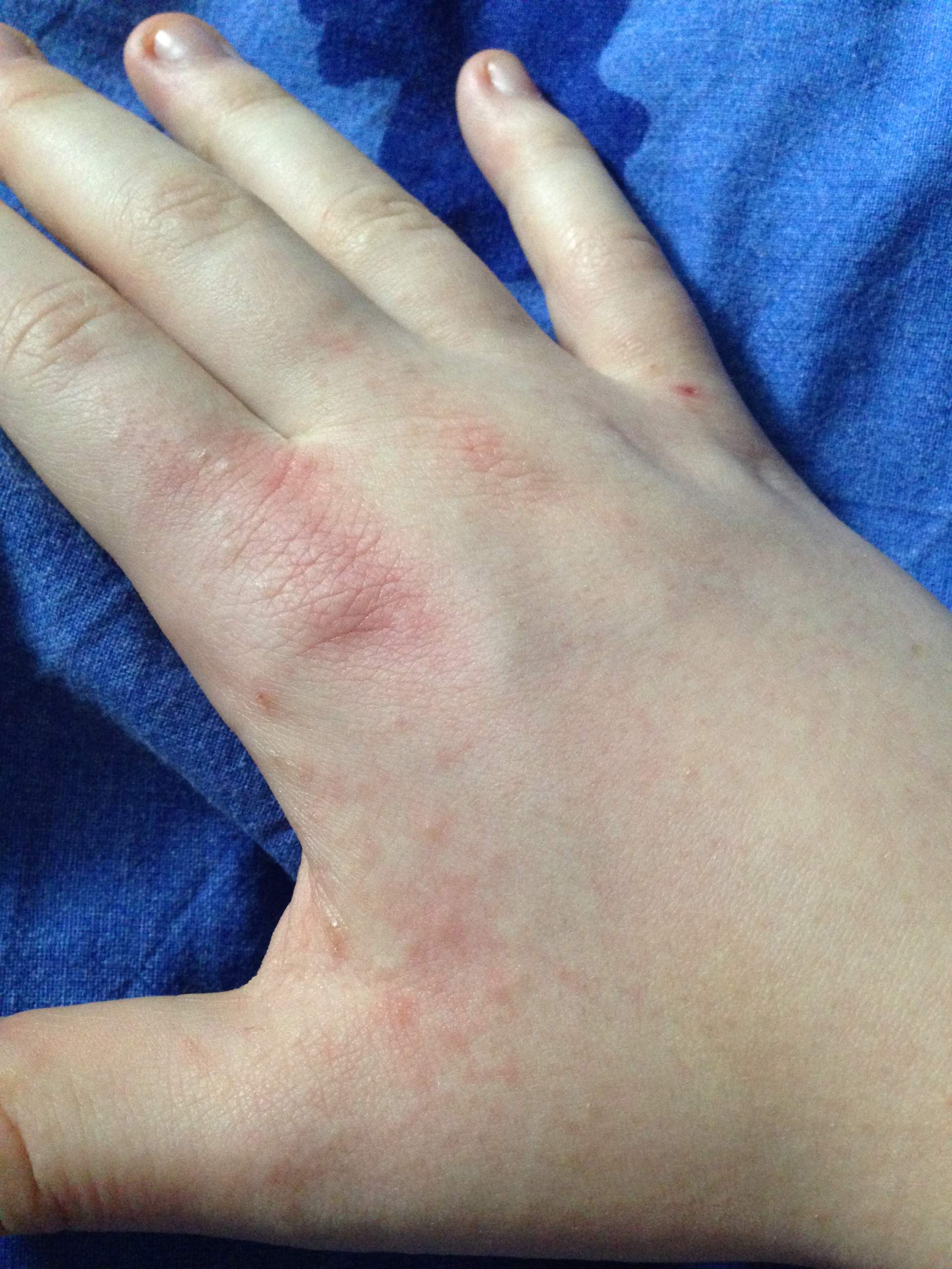 Was Ist Das Moglicherweise Kratze Krankheit Hand Juckreiz Was Ist Das Moglicherweise Kratze Krankheit Hand Juckreiz