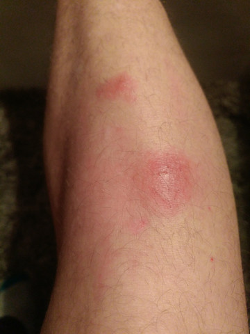 Was Ist Das Mucken Stich Wanzen Biss Gesundheit Haut