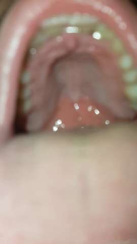 Durch oralverkehr mundsoor Oralverkehr: Lecktuch