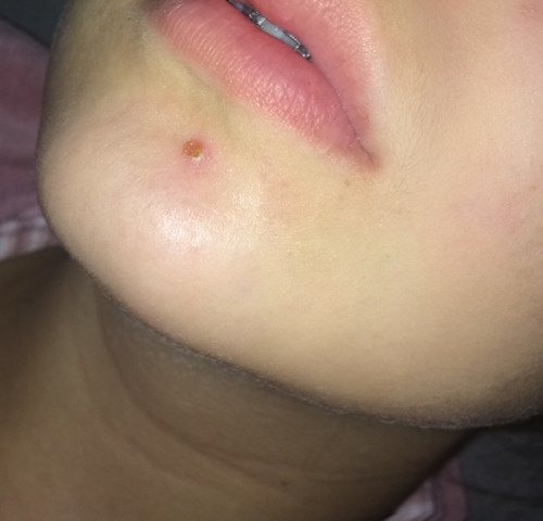 Was Ist Das Pickel Oder Herpes Gesundheit Arzt
