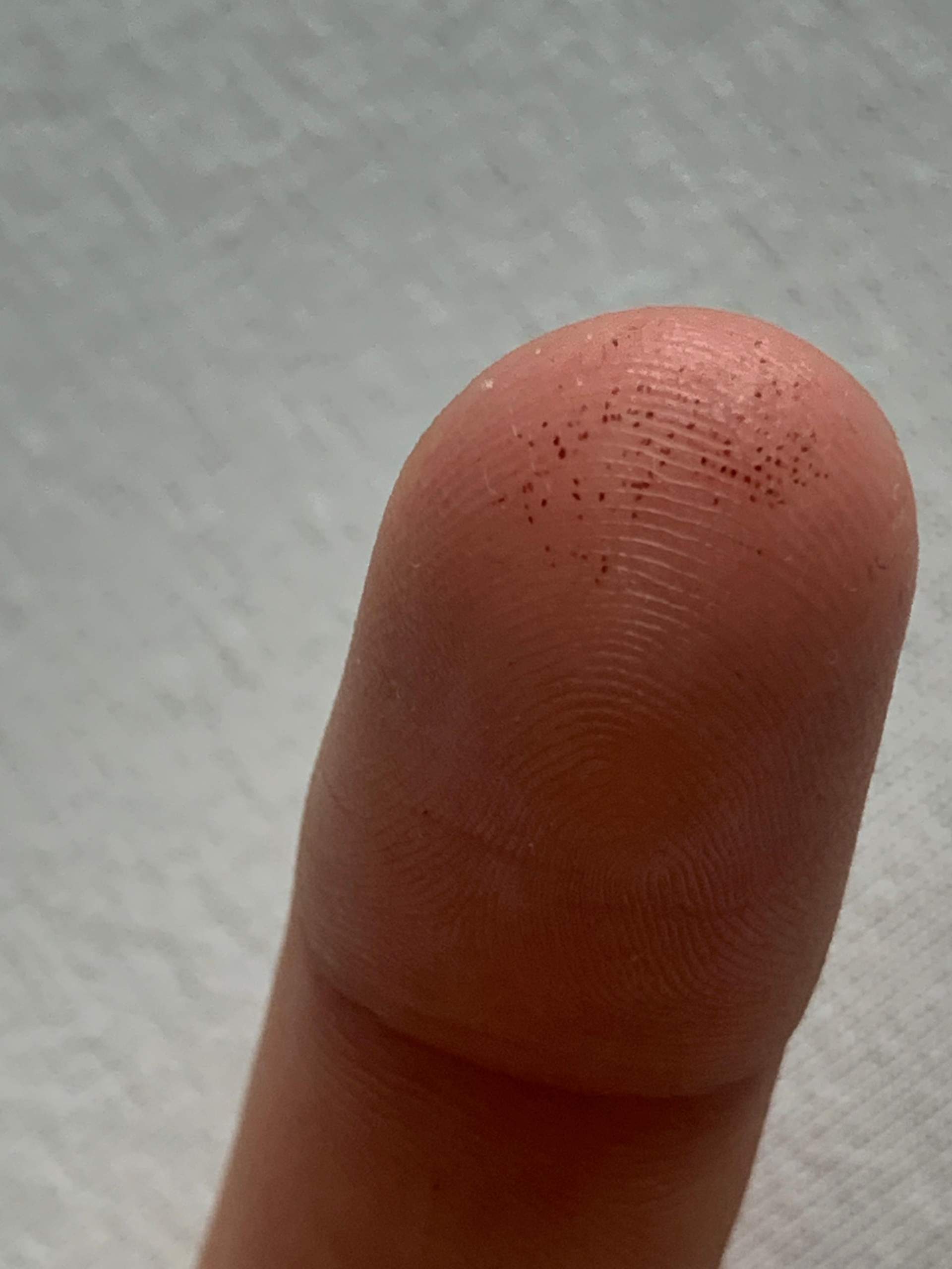 Was ist das? Punkte an der Fingerkuppe? (Gesundheit und Medizin, Haut ...