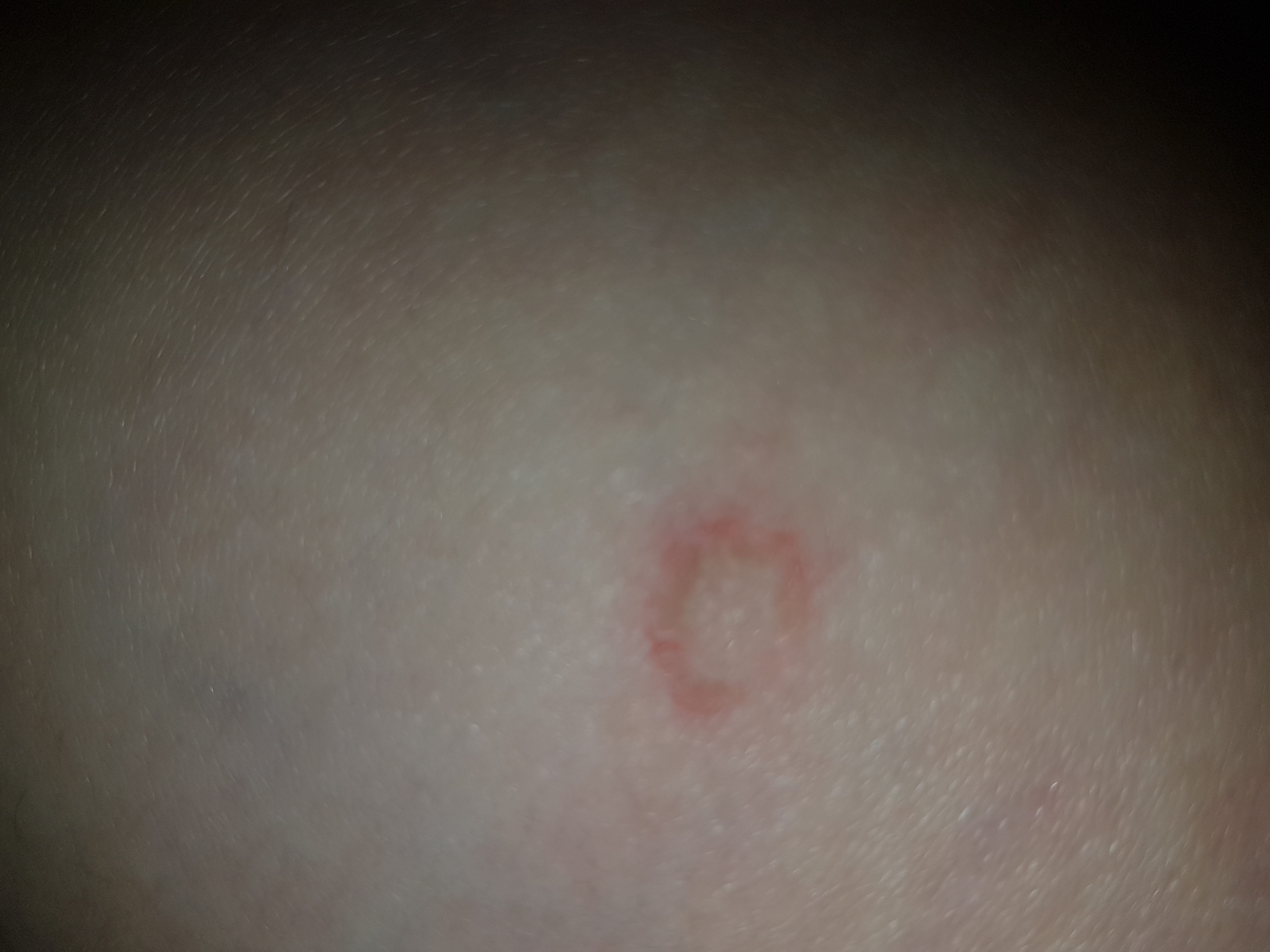 Was ist das (rot-weiße Flecken am ganzen Körper? (Arzt, Krankheit ...