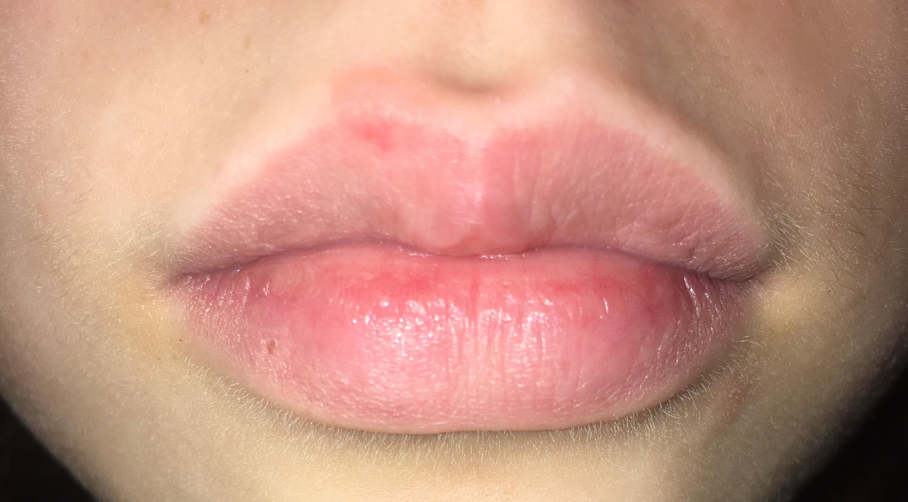 Was ist das rote an meiner Lippe? (Gesundheit und Medizin, Pickel, Warzen)