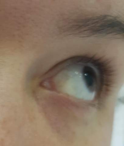 Was Ist Das Rote Im Auge Gesundheit Und Medizin Korper Augen Was Ist Das Rote Im Auge Gesundheit Und Medizin Korper Augen