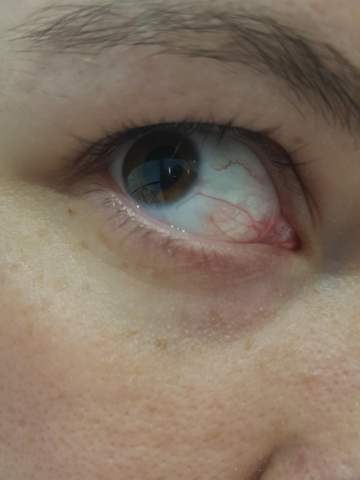 Was Ist Das Rote Im Auge Gesundheit Und Medizin Korper Augen Was Ist Das Rote Im Auge Gesundheit Und Medizin Korper Augen