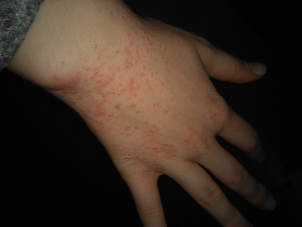 Was ist das? Rote Pickel auf Handrücken? (Gesundheit und Medizin, Haut, Hautarzt) pickel auf hand