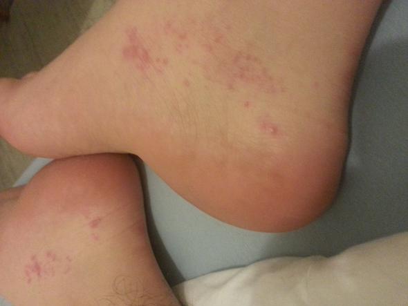 Was sind das für rote Punkte am Fuß? (Gesundheit und Medizin, Arzt, Haut) Was sind das für rote Punkte am Fuß? (Gesundheit und Medizin, Arzt, Haut)