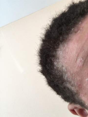 was ist das schuppenflechte hautpilz