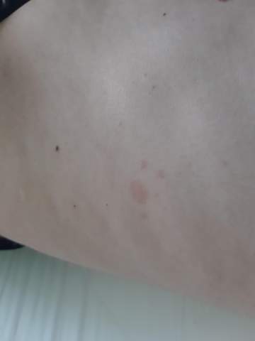 Was Ist Das Sieht Aus Wie Hautkrebs Oder Gesundheit Und Medizin Was Ist Das Sieht Aus Wie Hautkrebs Oder Gesundheit Und Medizin