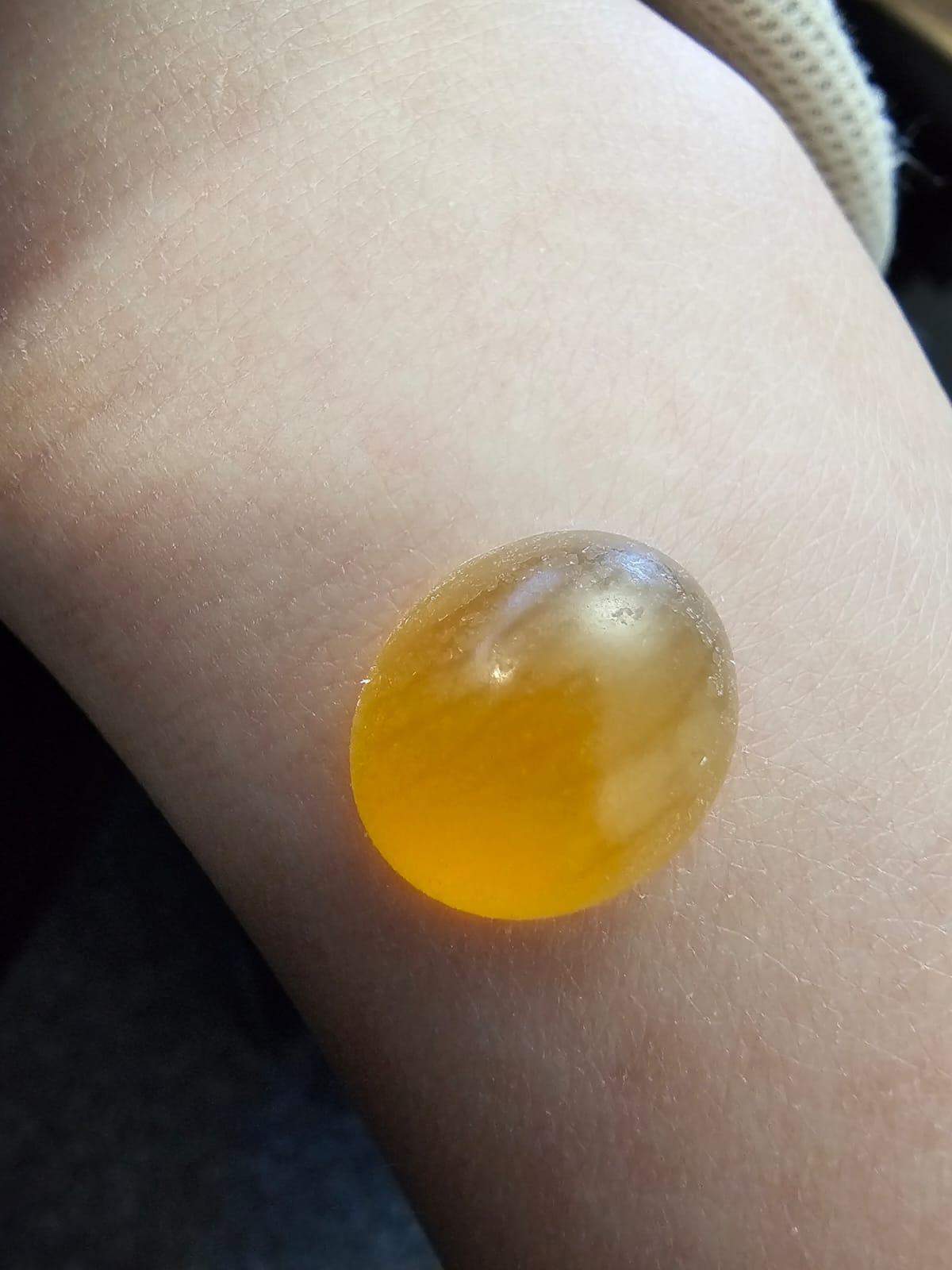 Was ist das sieht nach eine schlimme blase aus? (Pickel, Blasenentzündung)