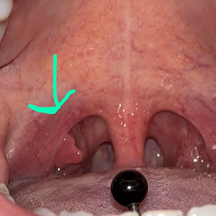 Was ist das? Sind das meine Mandeln? (Gesundheit und Medizin ...