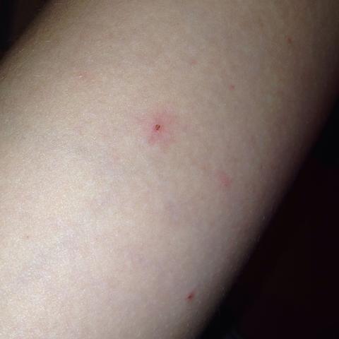 Was Ist Das Sind Das Milben Gesundheit Gucken Was Ist Das Sind Das Milben Gesundheit Gucken