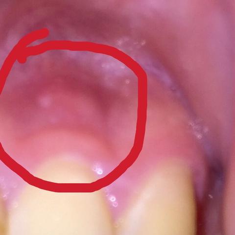 Das rot umkreiste ist der Bereich wo es weh tut wenn ich drauf drücke - (Schmerzen, Zähne, Zahnfleisch)
