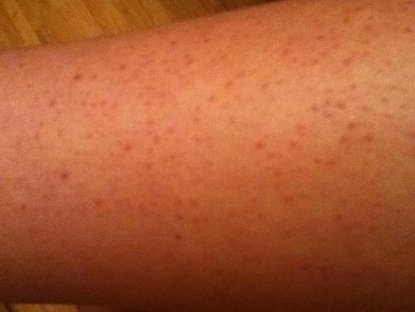 Was ist das und was kann ich dagegen tun? Bitte helft mir! (Pickel, Beine) pickel auf beinen