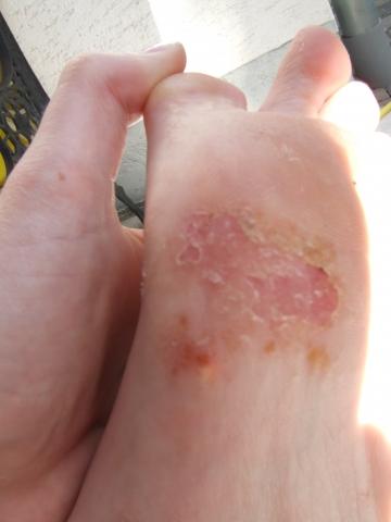 Was Ist Das Und Wie Bekomme Ich Das Weg Fusse Hand Juckreiz Was Ist Das Und Wie Bekomme Ich Das Weg Fusse Hand Juckreiz