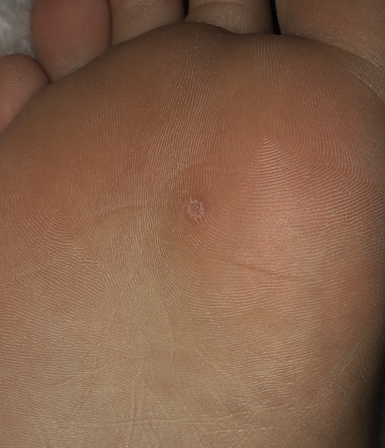 Was ist das unter mein Fuß, Hühnerauge? (Medizin, Arzt, Füße) Was ist das unter mein Fuß, Hühnerauge? (Medizin, Arzt, Füße)