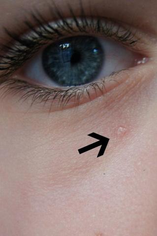 Was Ist Das Unter Meinem Auge Hubbel Hautunreinheit Haut Augen