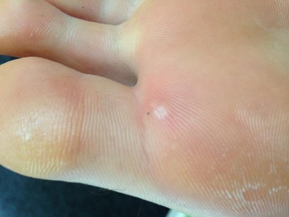Was Ist Das Unter Meinem Fuss Eine Warze Bild Haut Warzen Was Ist Das Unter Meinem Fuss Eine Warze Bild Haut Warzen