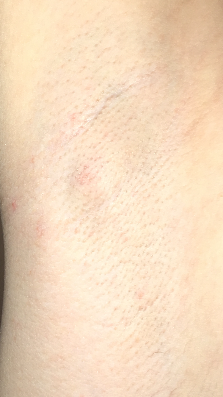 Was Ist Das Unter Meiner Achsel Habe Ich Krebs Gesundheit Und Medizin Gesundheit Was Ist Das Unter Meiner Achsel Habe Ich Krebs Gesundheit Und Medizin Gesundheit