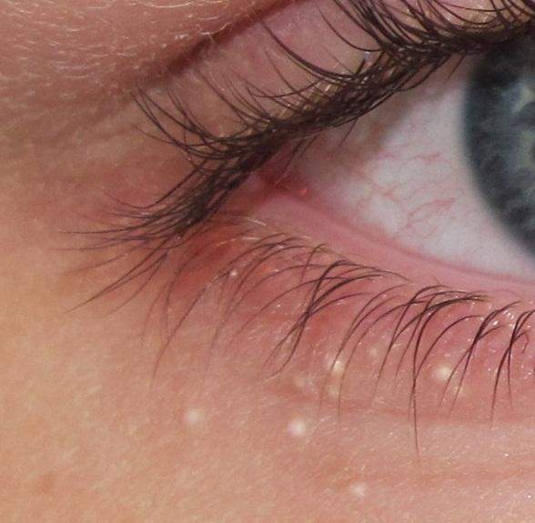 Was ist das unterm Auge? (Bild) (Gesundheit, Haut, Augen)