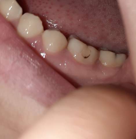 Was Ist Das Warum Habe Ich Einen Kreis Am Zahn Gesundheit Zahne Zahnarzt Was Ist Das Warum Habe Ich Einen Kreis Am Zahn Gesundheit Zahne Zahnarzt