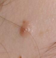 So sehen die Flecken aus - (Haut, Hautarzt, Muttermal)