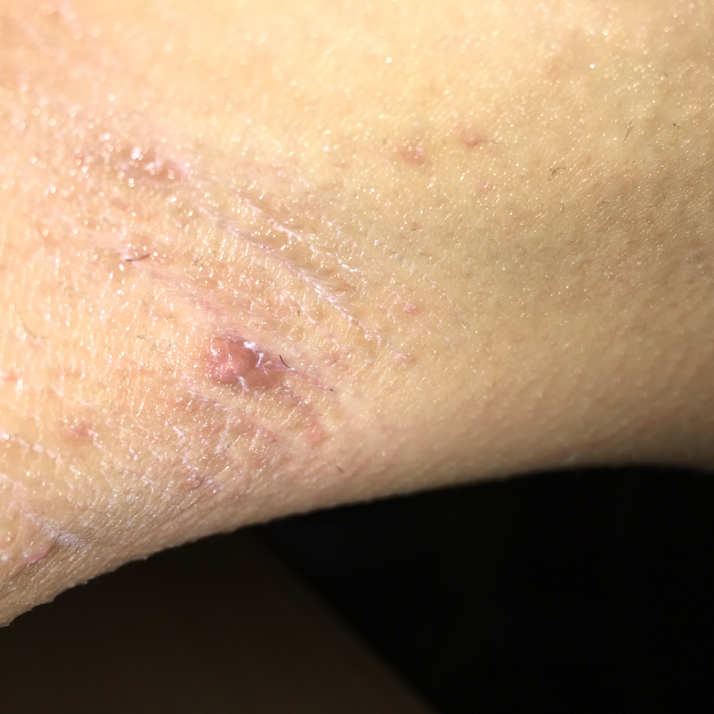 was ist das warze unter der achsel