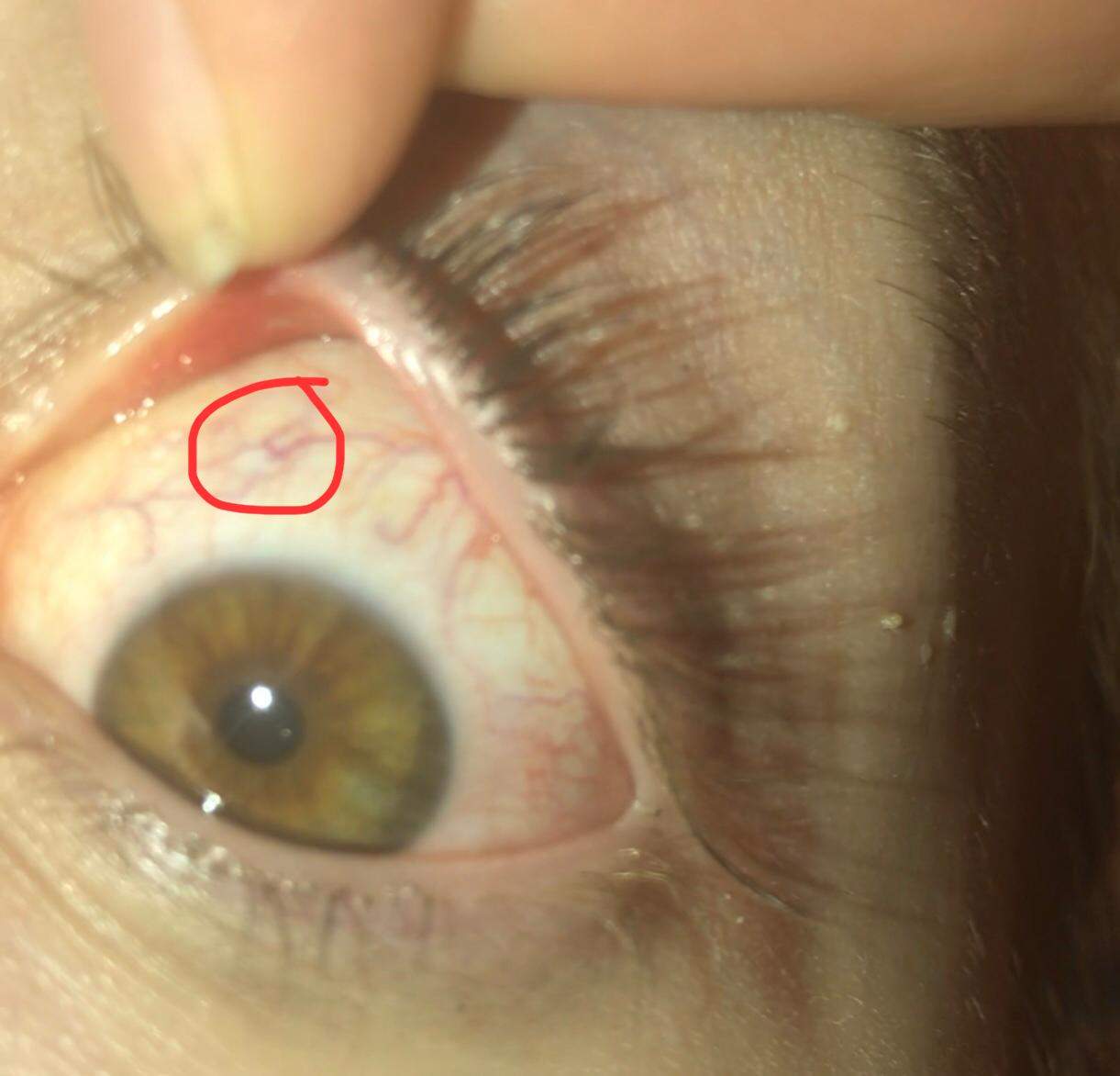 Was ist das weiße in meinem Auge? (Gesundheit und Medizin, Augen ...