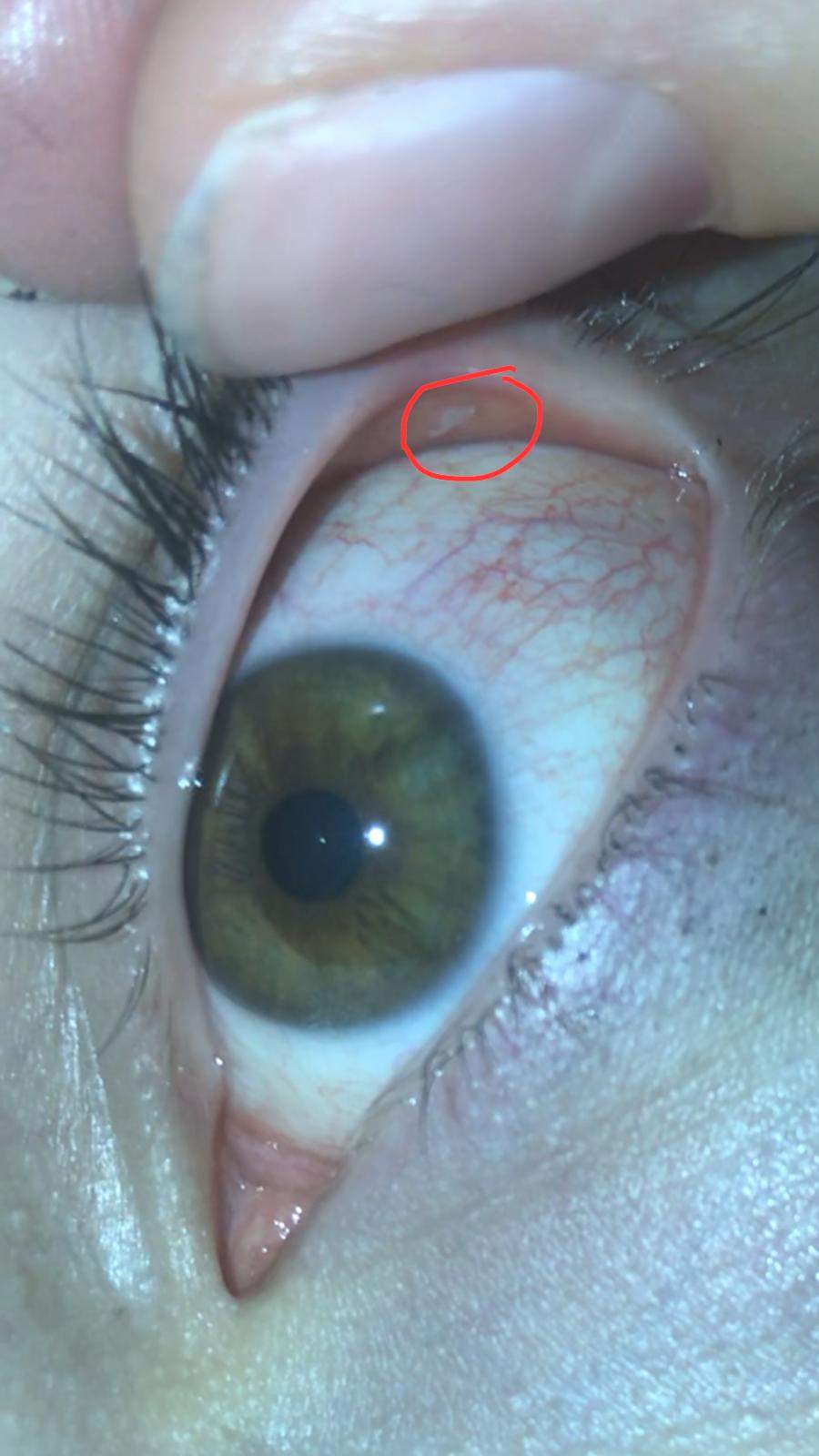 Was Ist Das Weiße Im Auge