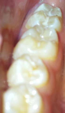 Weiße Schicht zwischen den und beim letzten Zahn ein schwarzer Fleck (Karies?) - (Zähne, Zahnarzt, Zahnmedizin)