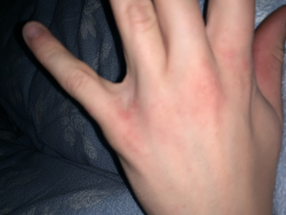 Was Ist Das Zwischen Meinen Fingern Gesundheit Und Medizin Hand Was Ist Das Zwischen Meinen Fingern Gesundheit Und Medizin Hand