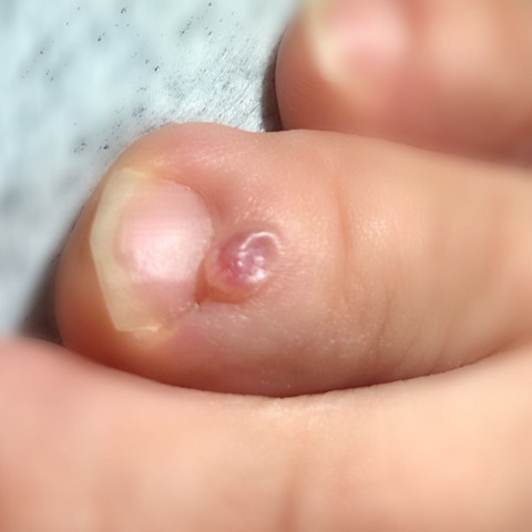 War zuerst eine Blase weil ein Schuh gedrückt hat , nun geht es nicht weg - (Gesundheit, Medizin, Arzt)