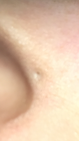 Pickel? - (Pickel, Nase)
