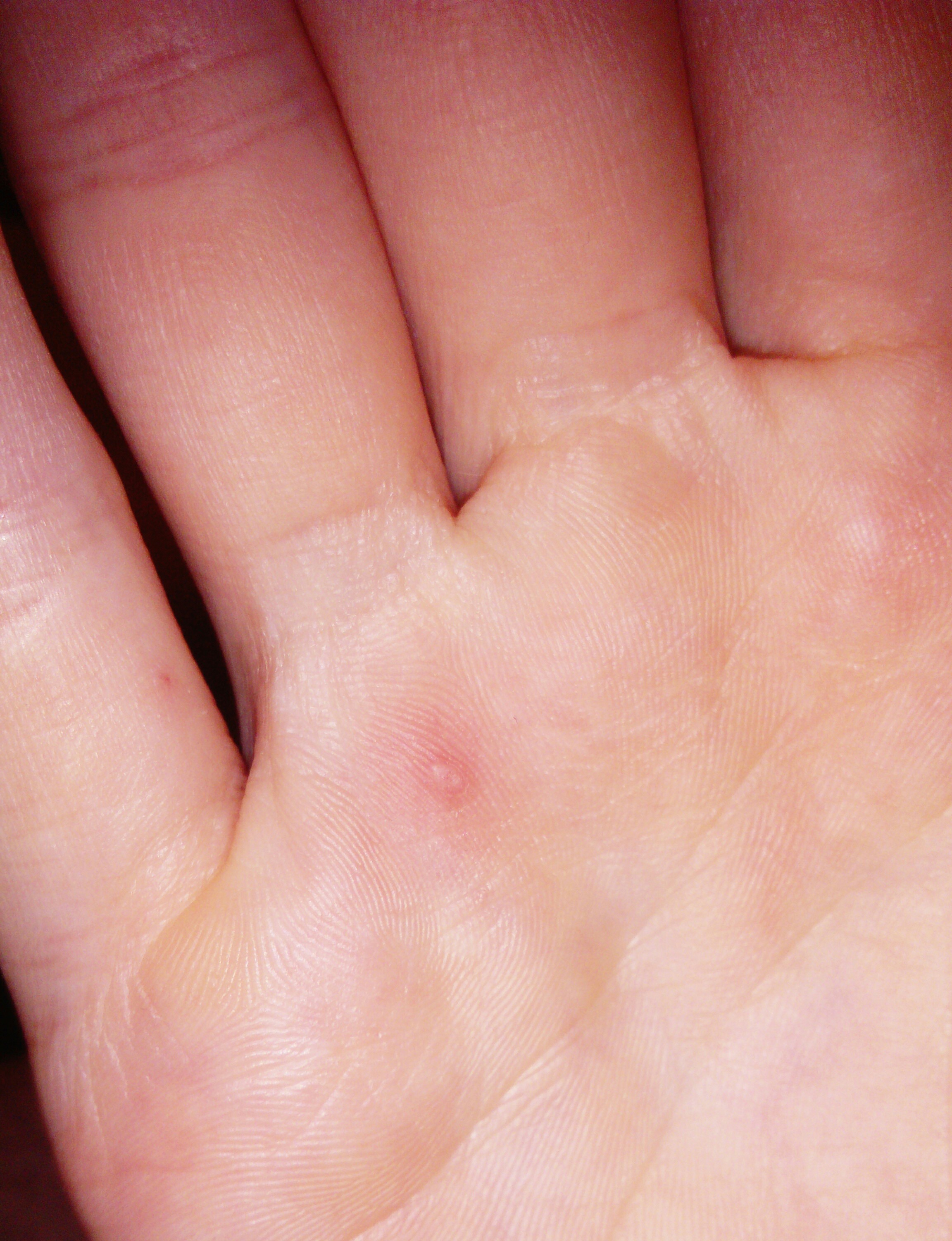 Was ist dass auf meiner Handfläche? (Arzt, Krankheit, Haut) pickel hand