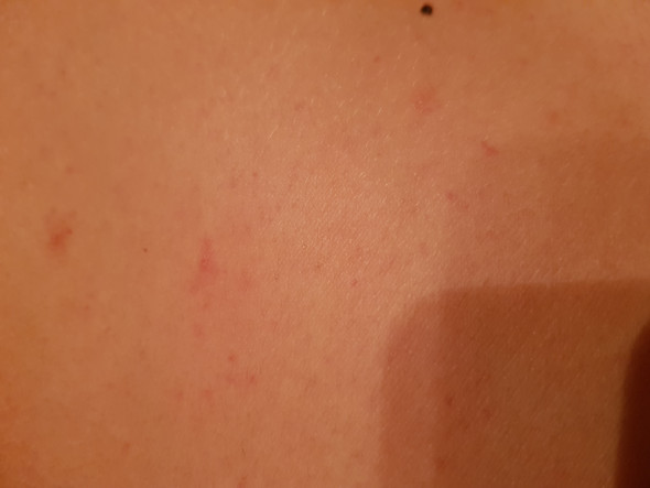 - (Gesundheit, Haut, Gesundheit und Medizin)
