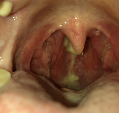 Was Ist Der Gelbliche Schleim Im Rachen Gesundheit Und Medizin Rachenentzundung Was Ist Der Gelbliche Schleim Im Rachen Gesundheit Und Medizin Rachenentzundung