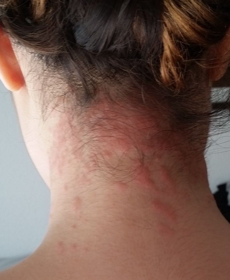 Was ist des auf mein Nacken? (Hautarzt)