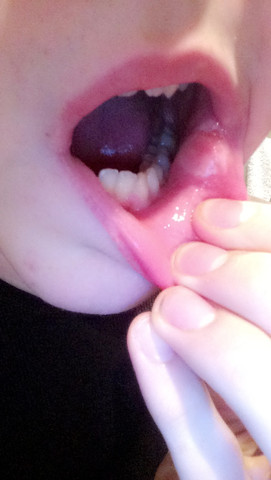 Blase im Mund - (Körper, Virus, Hygiene)